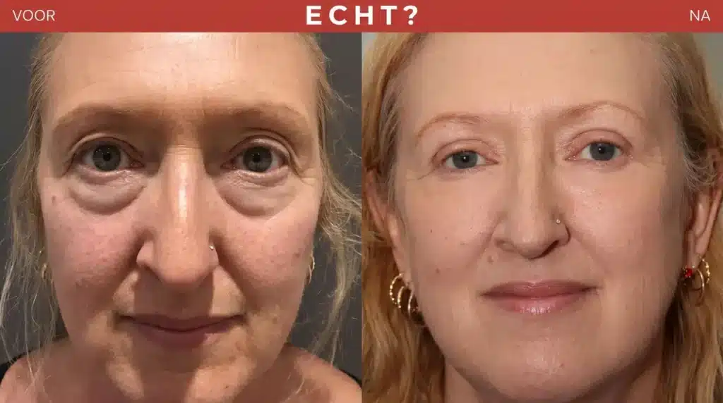 Voor-en-na-vergelijking: huidbeeld voor en na het gebruik van anti-aging