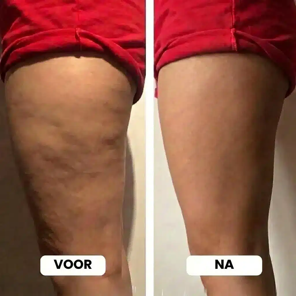 Cellulitis op de dijen voor en na in vergelijking