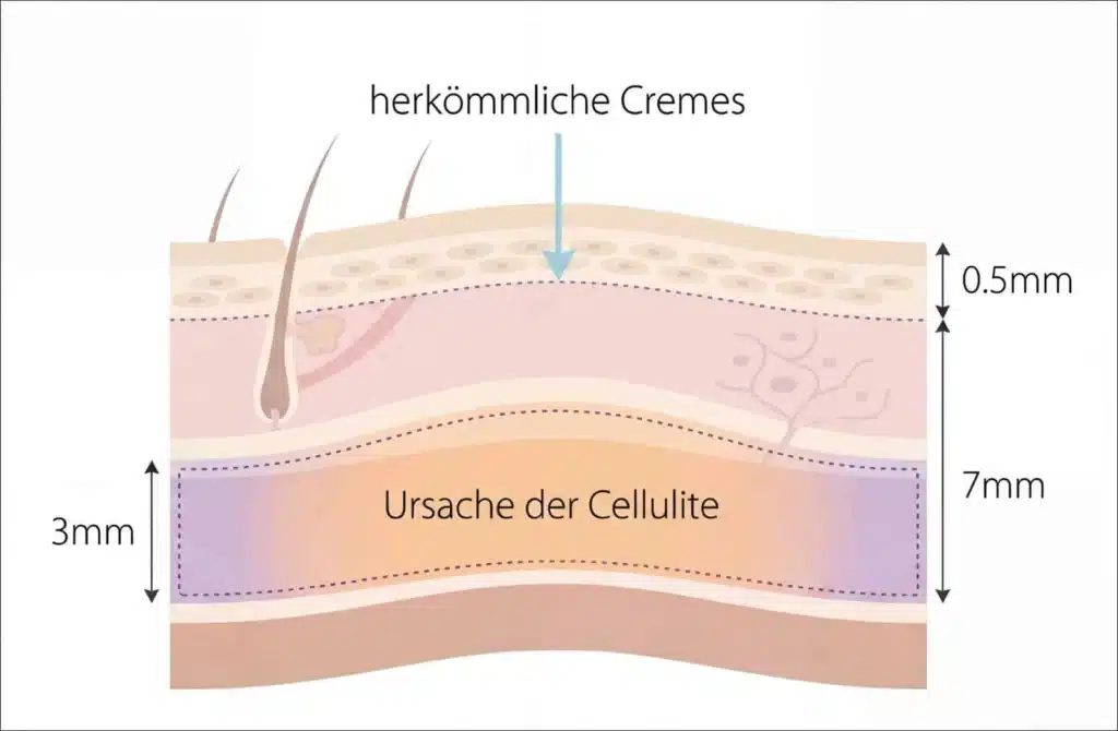 Infografik: Eindringtiefe herkömmlicher Cremes 0,5 mm vs. Ursache bei 3-7 mm